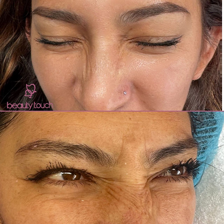 Limpieza facial profesional en Quito