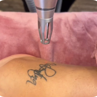 remocion laser de tatuajes en Valle de los Chillos