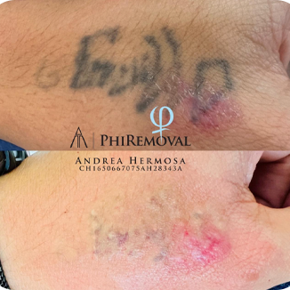 remocion laser de tatuajes en Valle de los Chillos
