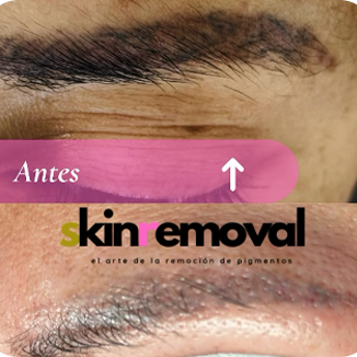 remocion de tatuajes en Valle de los Chillos