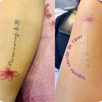 remocion laser de tatuajes en Valle de los Chillos