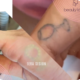 remocion laser de tatuajes en Valle de los Chillos