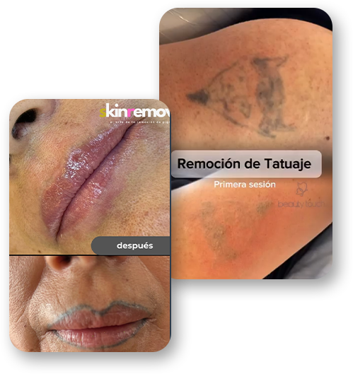 remoción de tatuajes en valle de los chillos