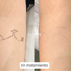 Tipos de remoción de pigmentos en Valle de los Chillos
